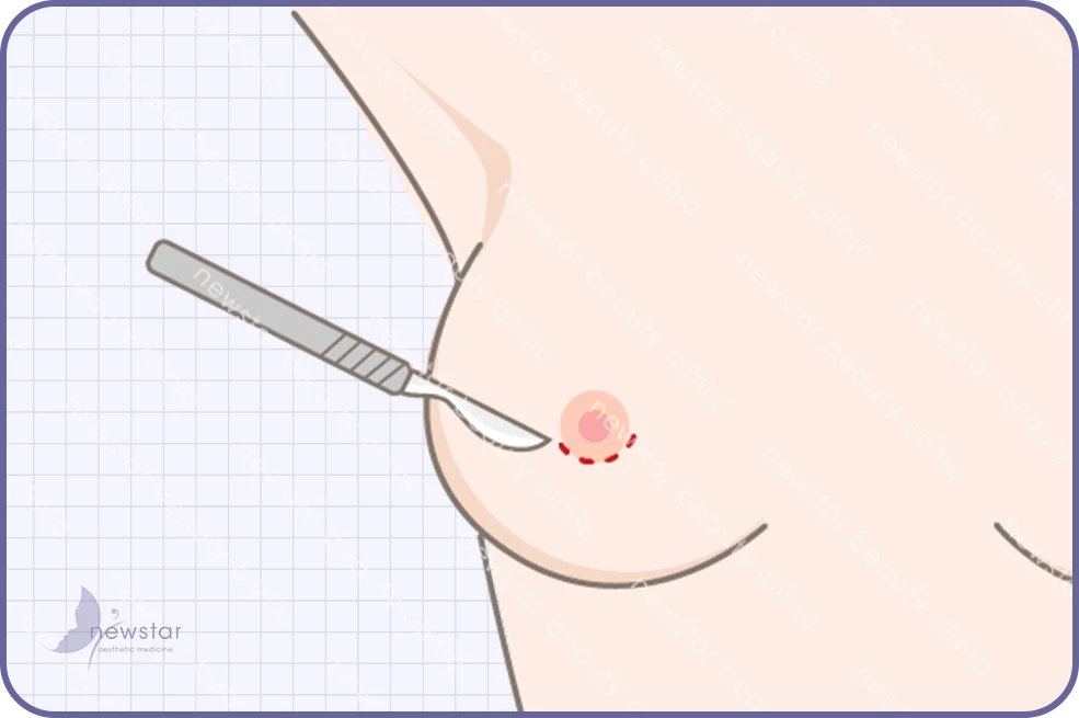 乳暈切口03