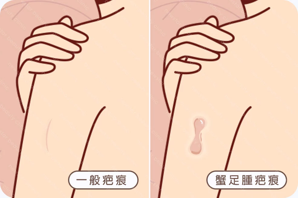 隆乳切口評估方式