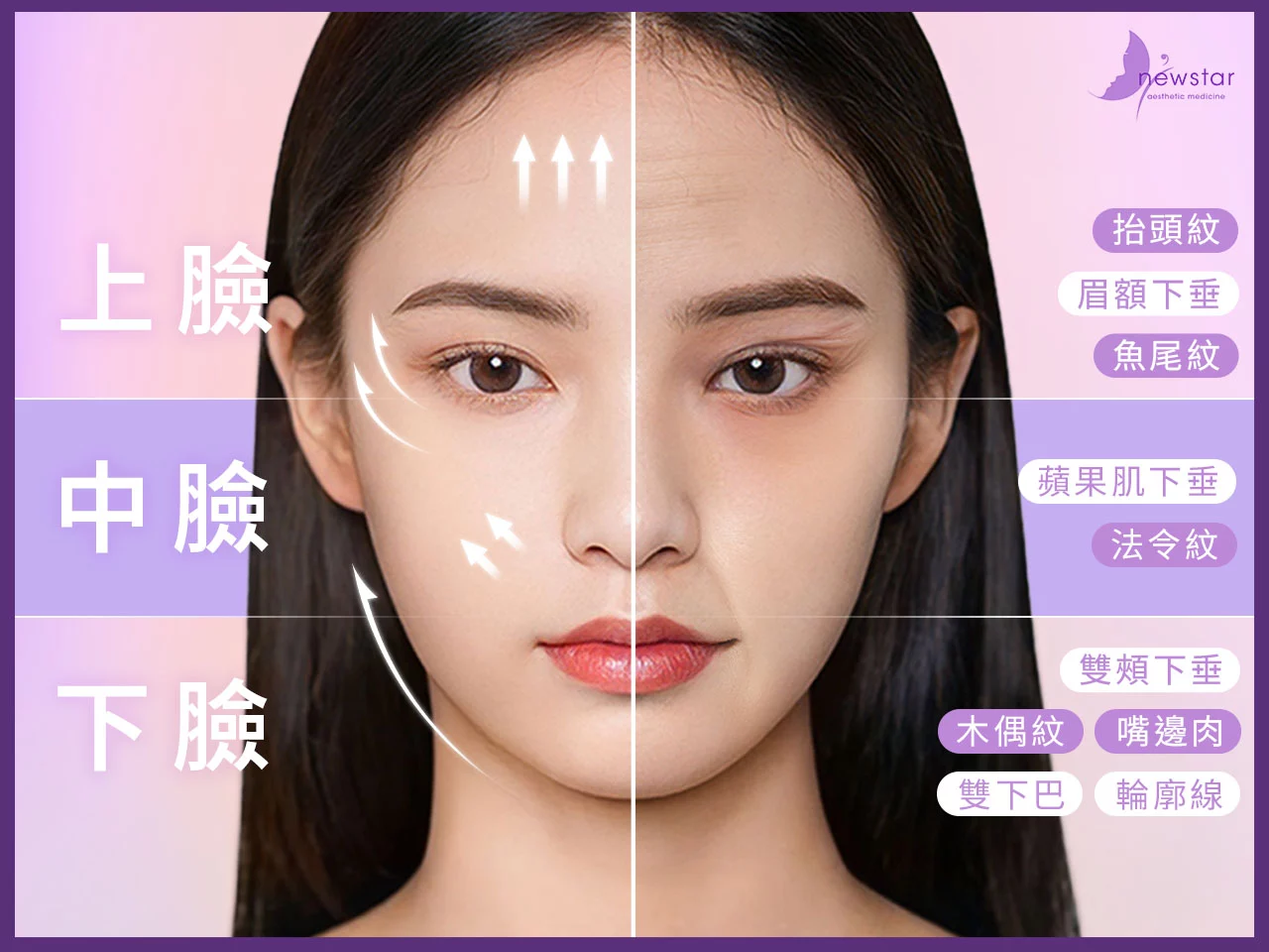 埋線拉提_要埋幾條才有效