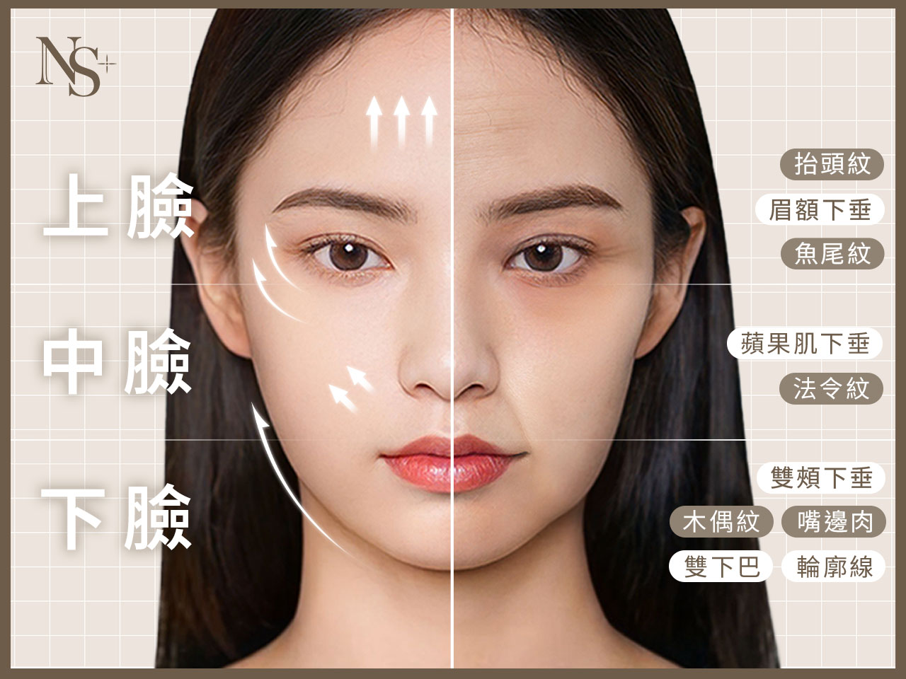 埋線(上中下臉)(嘴邊肉)