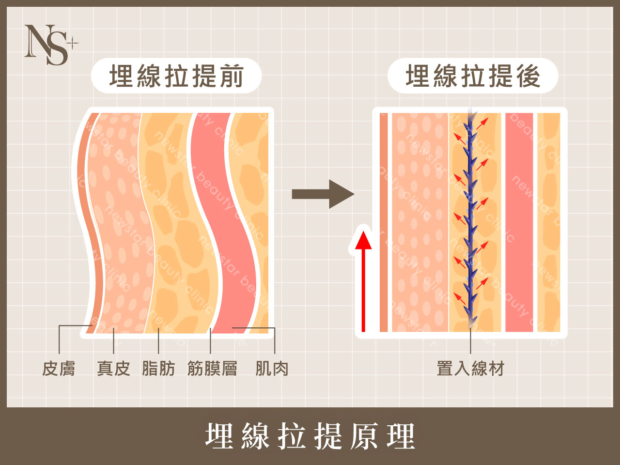 埋線拉提_埋線拉提原理