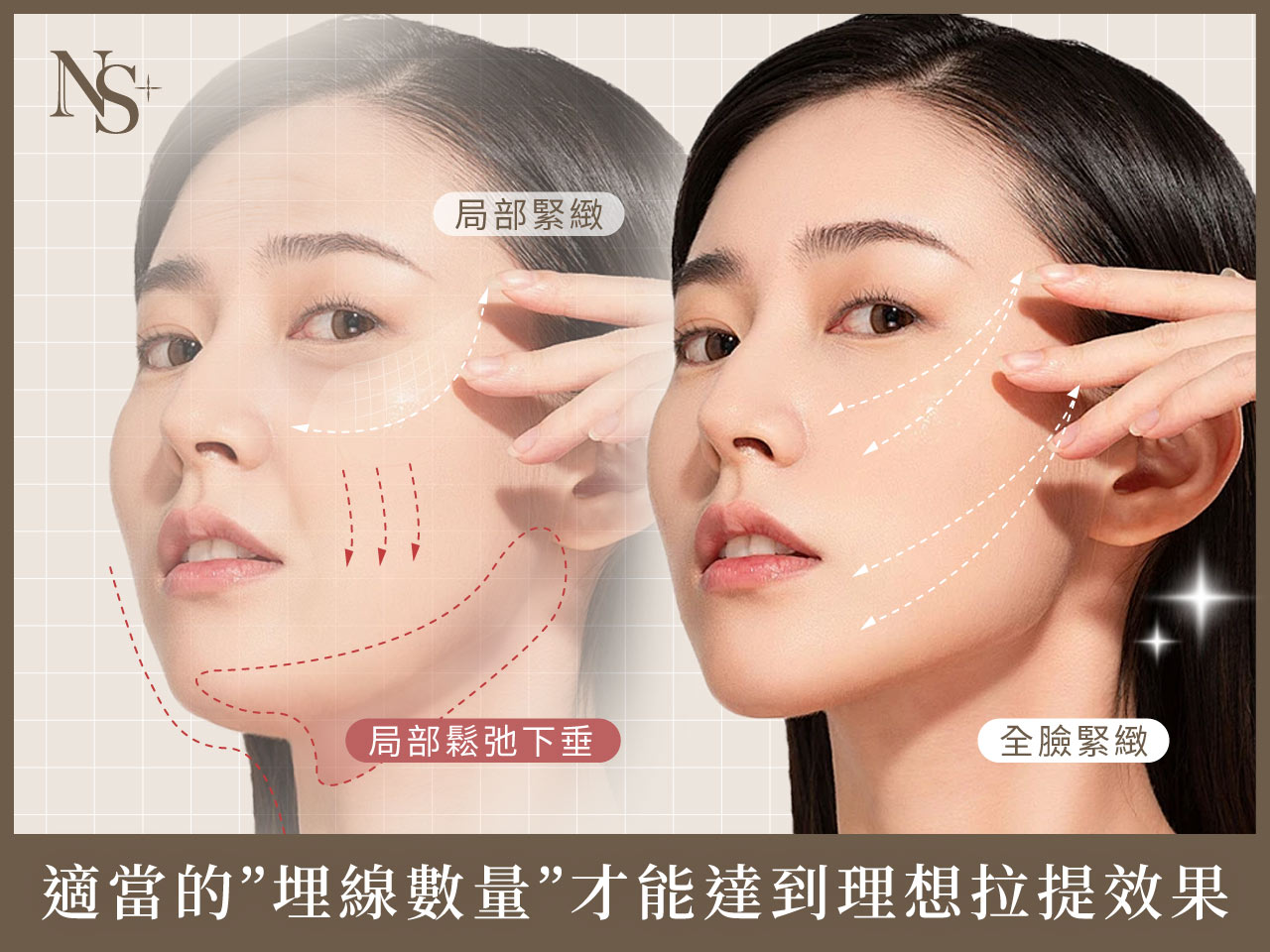 埋線拉提_埋線線材數量