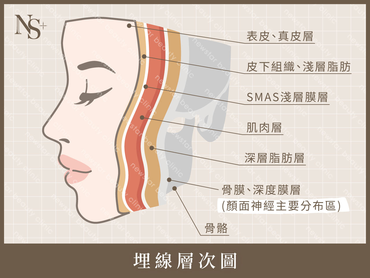 埋線拉提_埋線層次圖