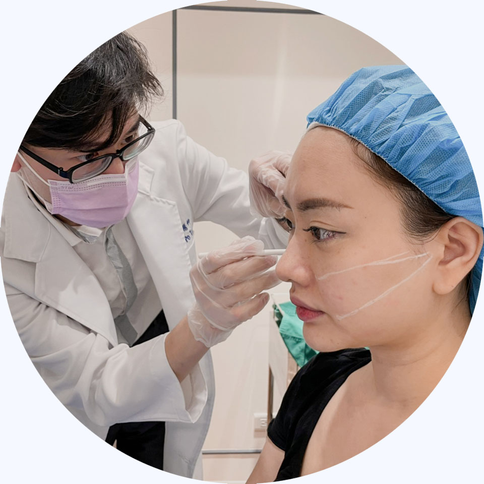 埋線拉提_療程步驟_定位標記