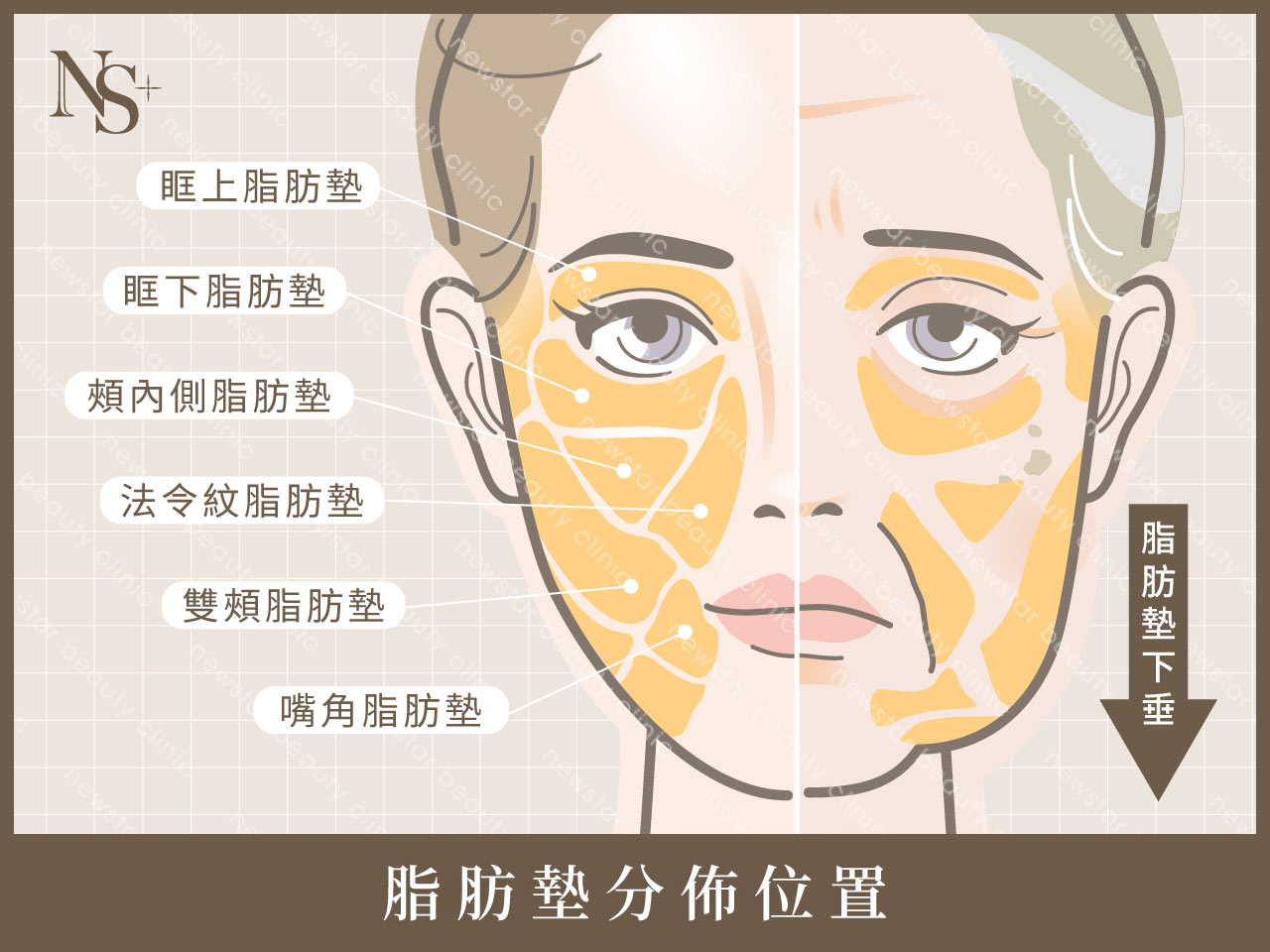 埋線拉提_脂肪墊下垂