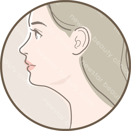 埋線拉提_適合對象_下顎線