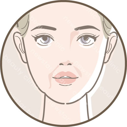 埋線拉提_適合對象_法令