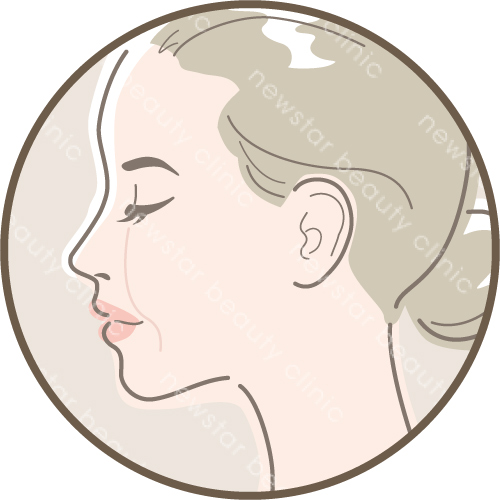 埋線拉提_適合對象_蘋果肌