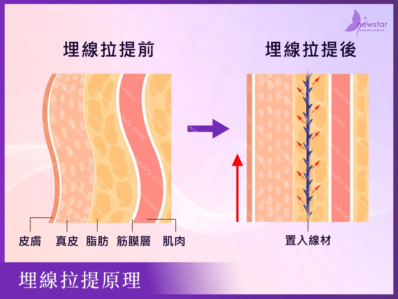 埋線拉提_埋線拉提原理
