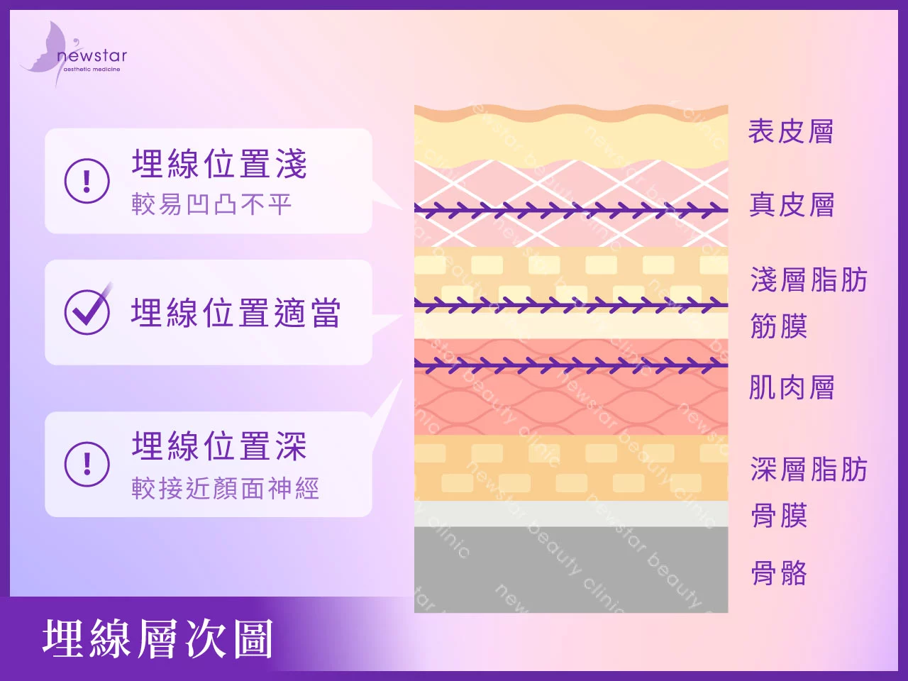 埋線拉提_埋線層次圖