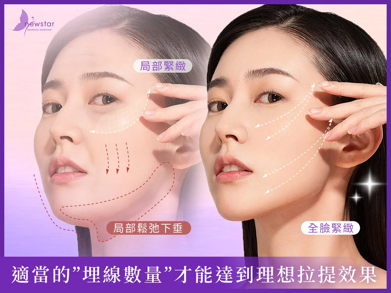 埋線拉提_埋線線材數量