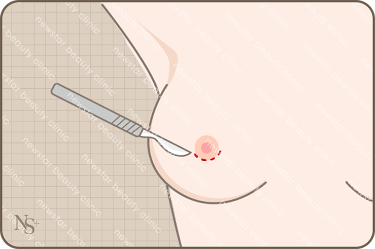 隆乳_四大切口位置_乳暈切口
