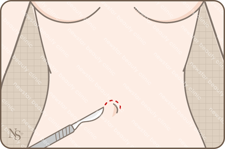 隆乳_四大切口位置_肚臍切口