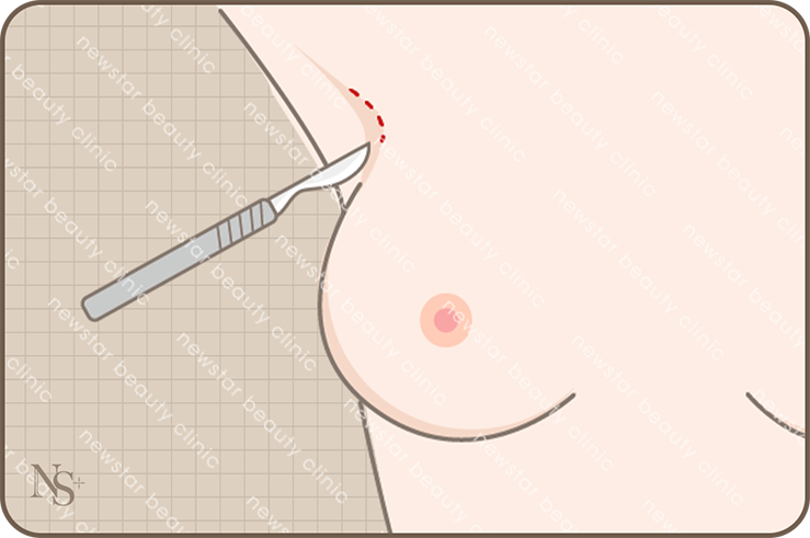 隆乳_四大切口位置_腋下切口