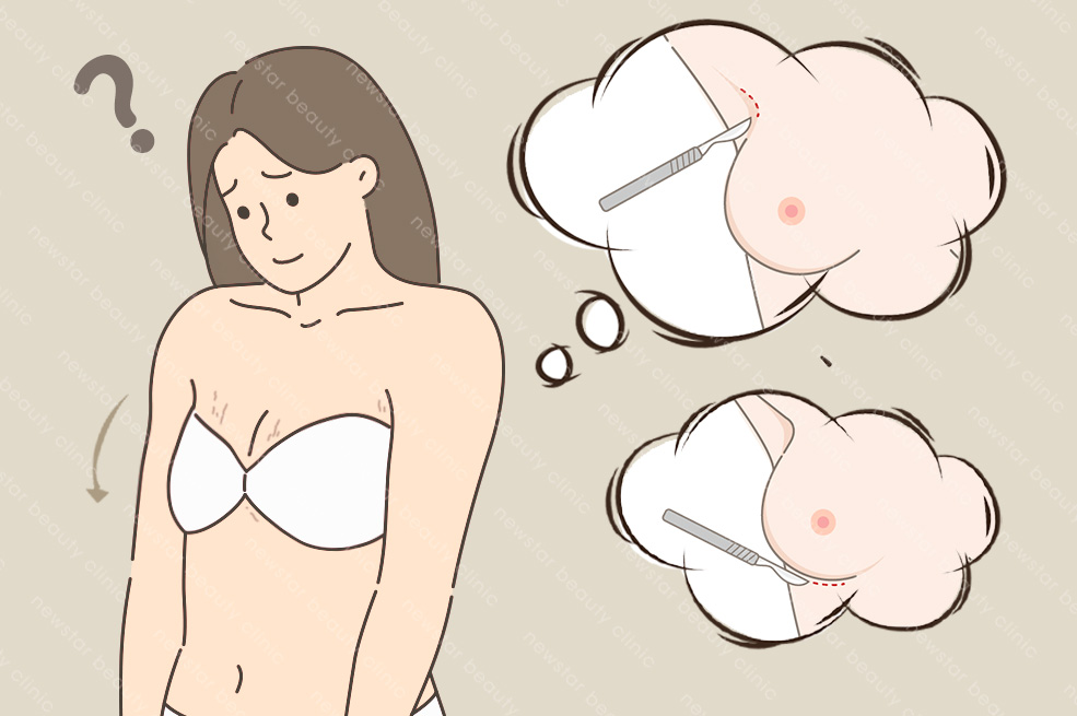 隆乳切口_依據要求選擇最佳切口_皮膚鬆弛、下垂程度01