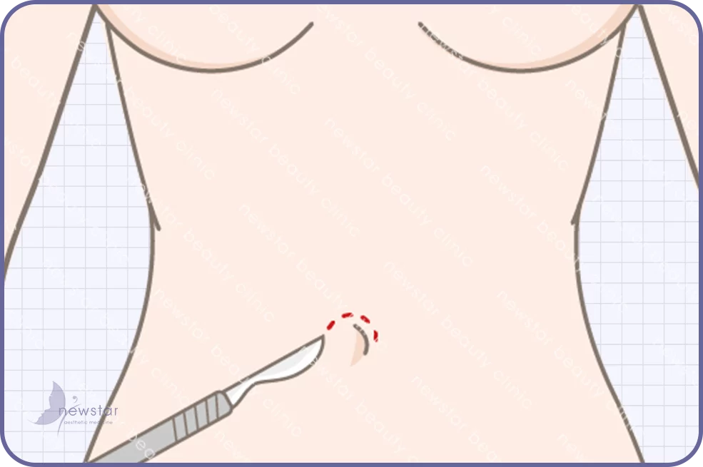 隆乳四大切口位置 肚臍切口05