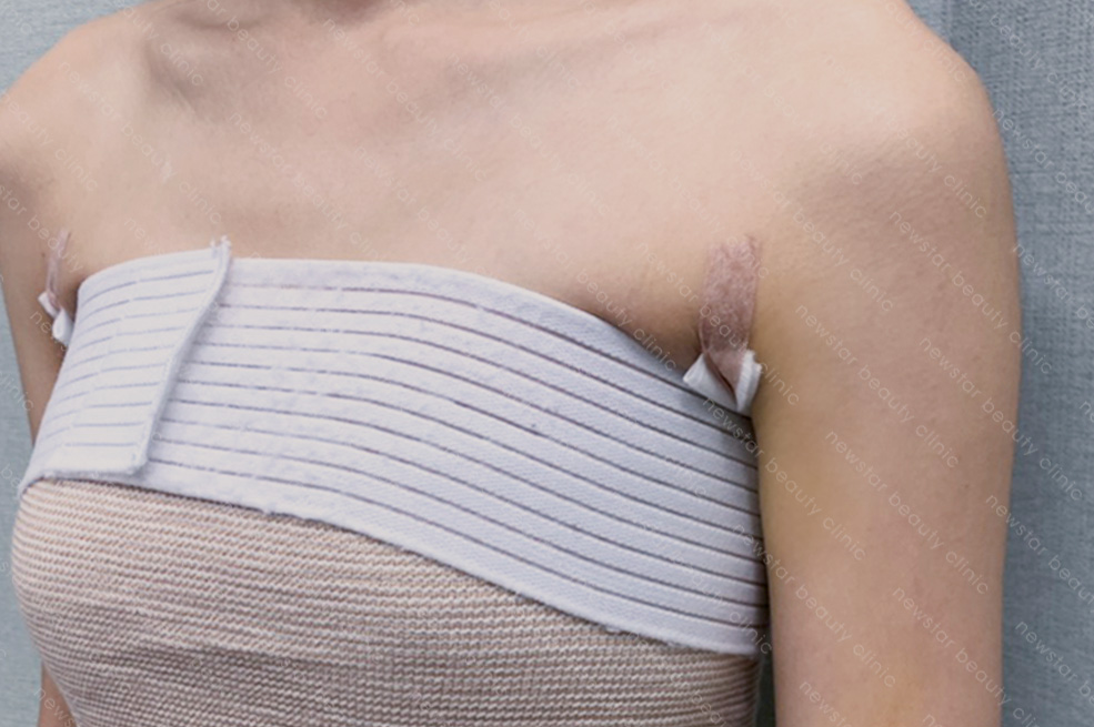隆乳術後恢復_保持傷口乾燥
