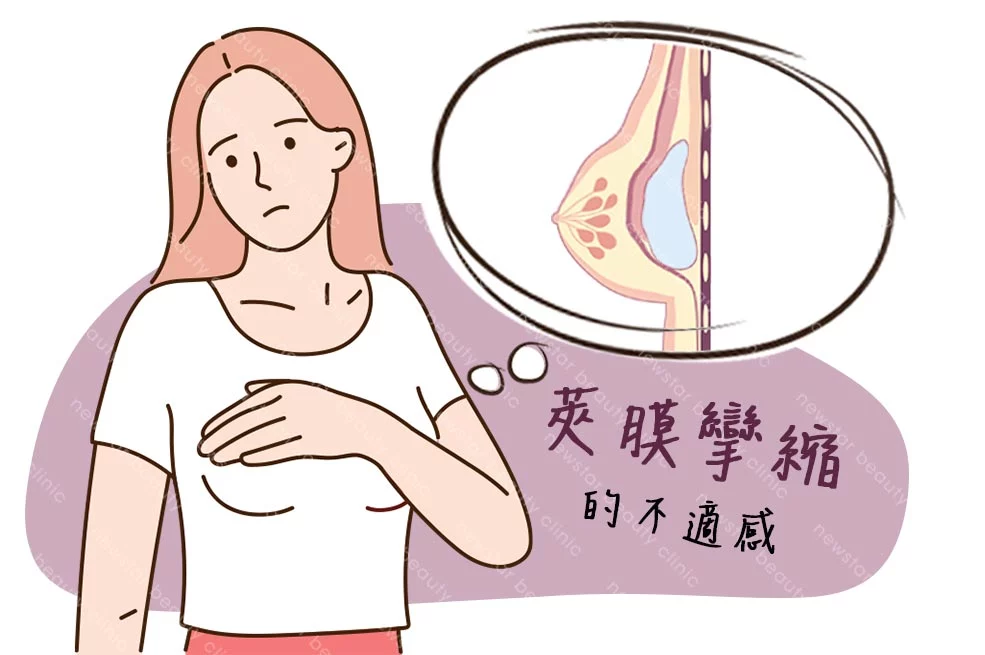 莢膜攣縮01