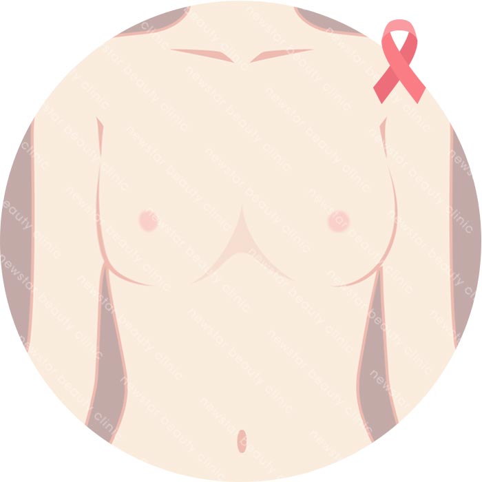 假體適合那些人_乳房重建01