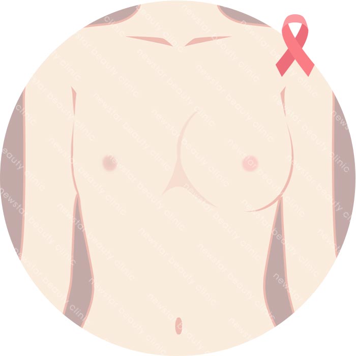 假體適合那些人_乳房重建02