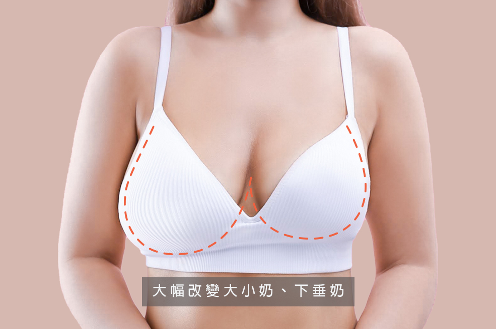 假體隆乳的優缺點_大小奶改善