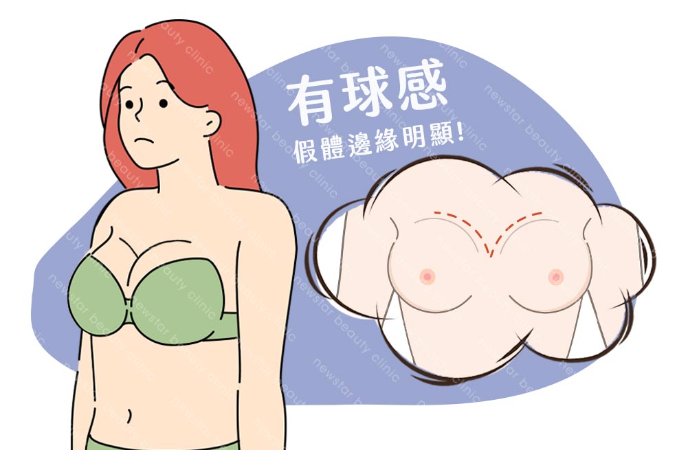 假體風險缺點_邊緣感05