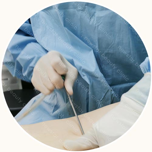 回填過程_取出脂肪