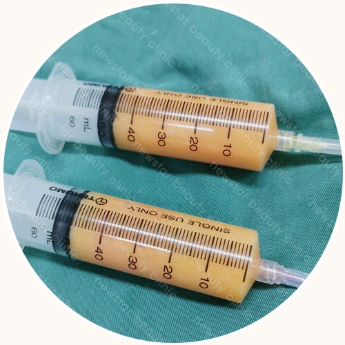 回填過程_脂肪回填