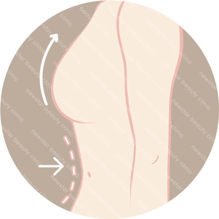 自體脂肪隆乳適合那些人_塑身豐胸01