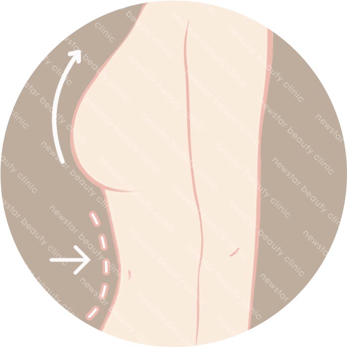 自體脂肪隆乳適合那些人_塑身豐胸02
