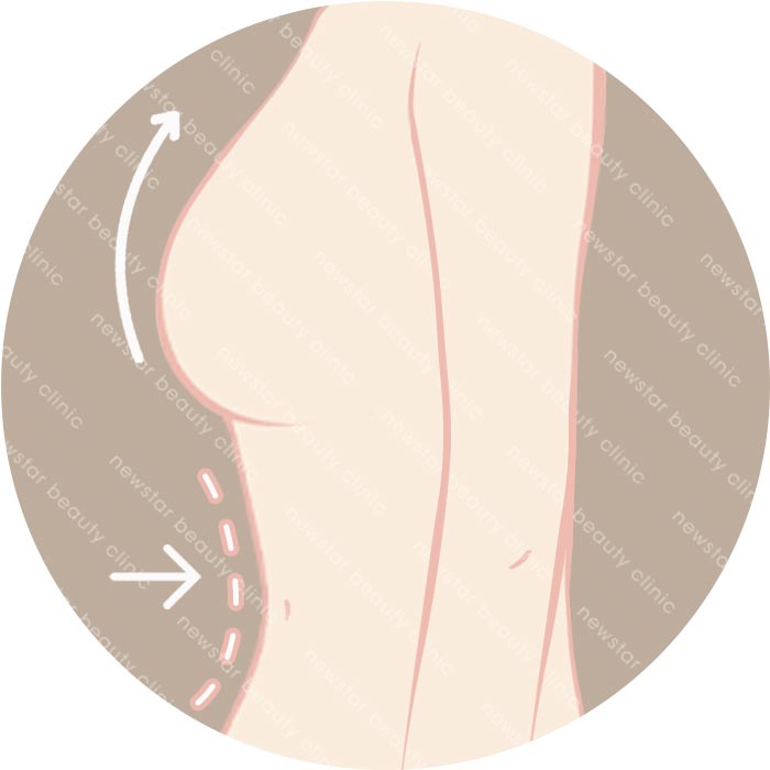自體脂肪隆乳適合那些人_塑身豐胸03