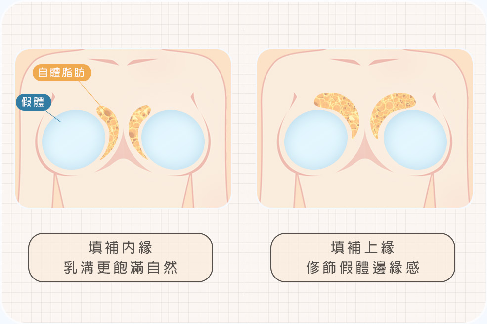複合式脂感隆乳_補上胸及乳溝01