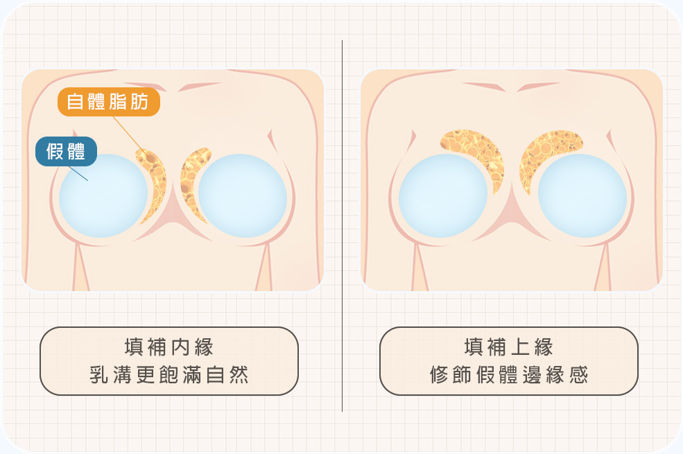 複合式脂感隆乳_補上胸及乳溝02