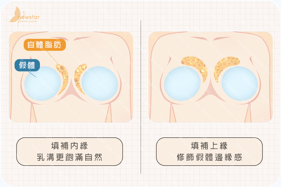 複合式脂感隆乳_補上胸及乳溝04