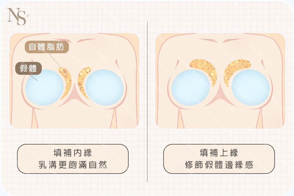 複合式脂感隆乳(咖啡)