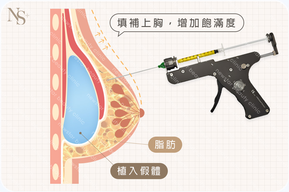 複合式脂感隆乳(咖啡)(胸)