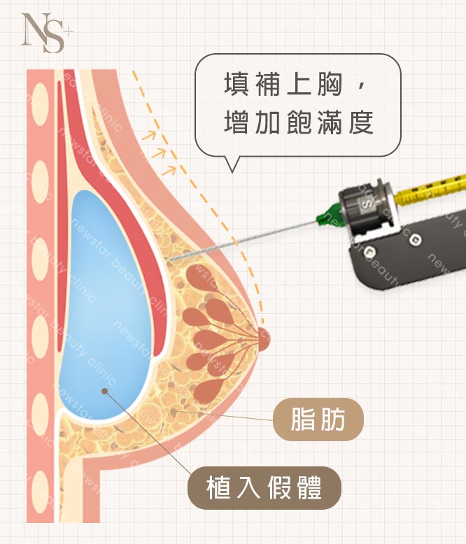 複合式脂感隆乳(手機版)(咖)