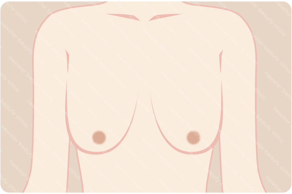 複合式質感隆乳適合那些人_下垂