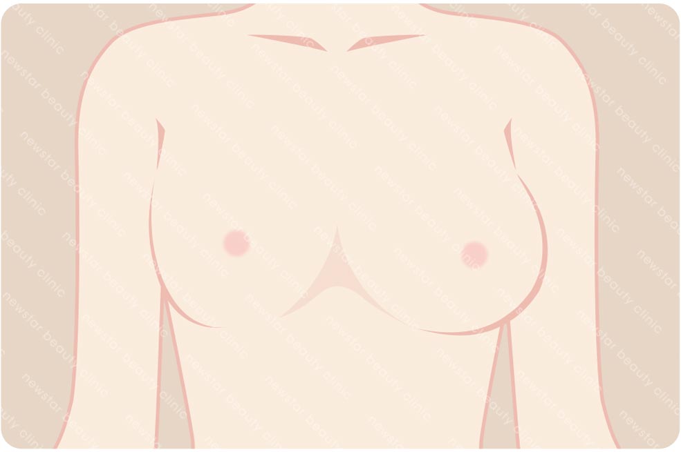 複合式質感隆乳適合那些人_不對襯01