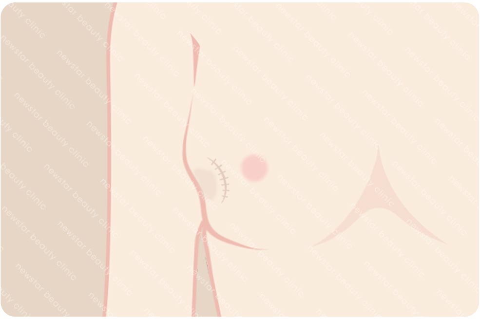 複合式質感隆乳適合那些人_切過腫瘤凹陷01