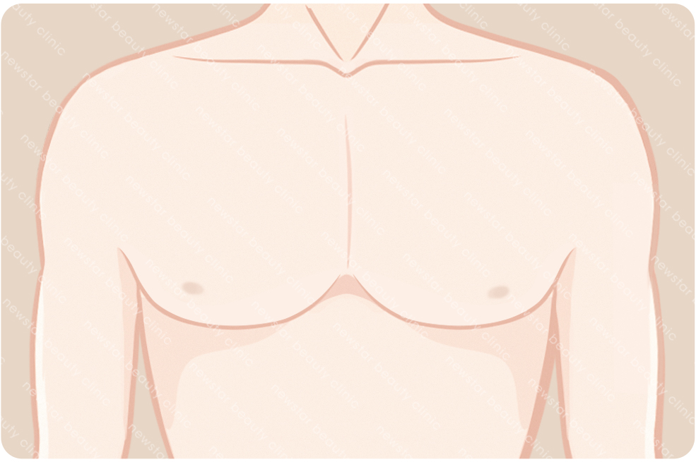 複合式質感隆乳適合那些人_跨性別004