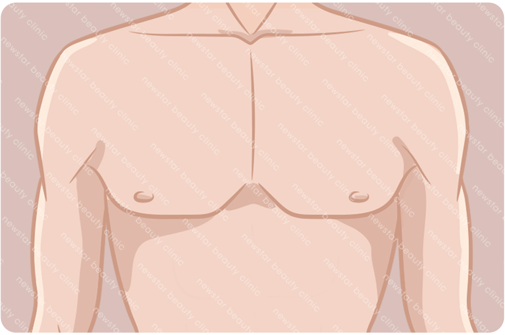 複合式質感隆乳適合那些人_跨性別01