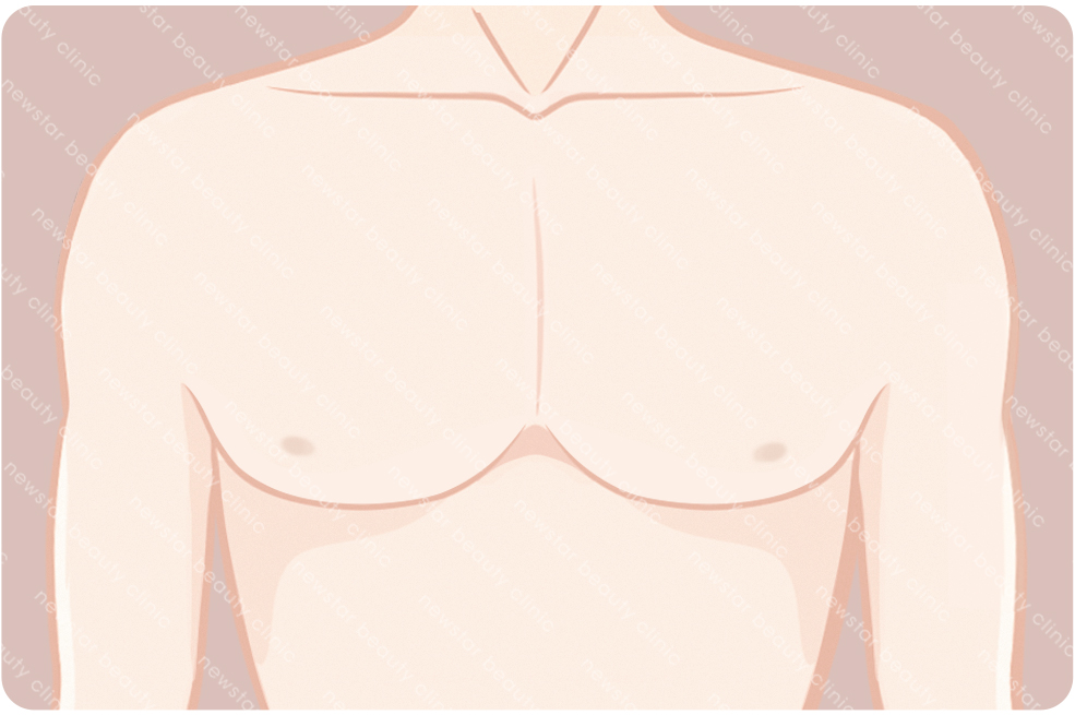 複合式質感隆乳適合那些人_跨性別04