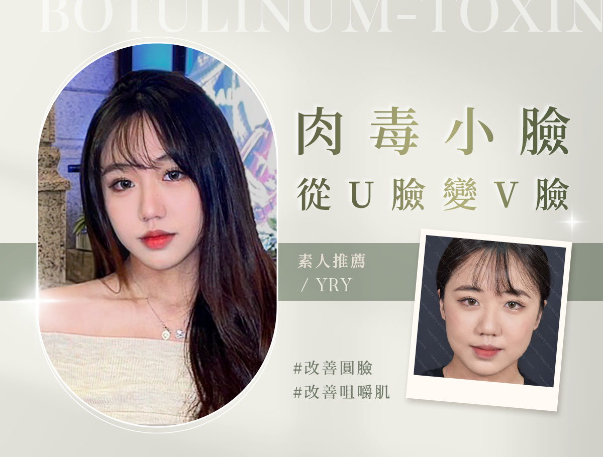 肉毒小臉_微整官網案例(外BN)_YRY