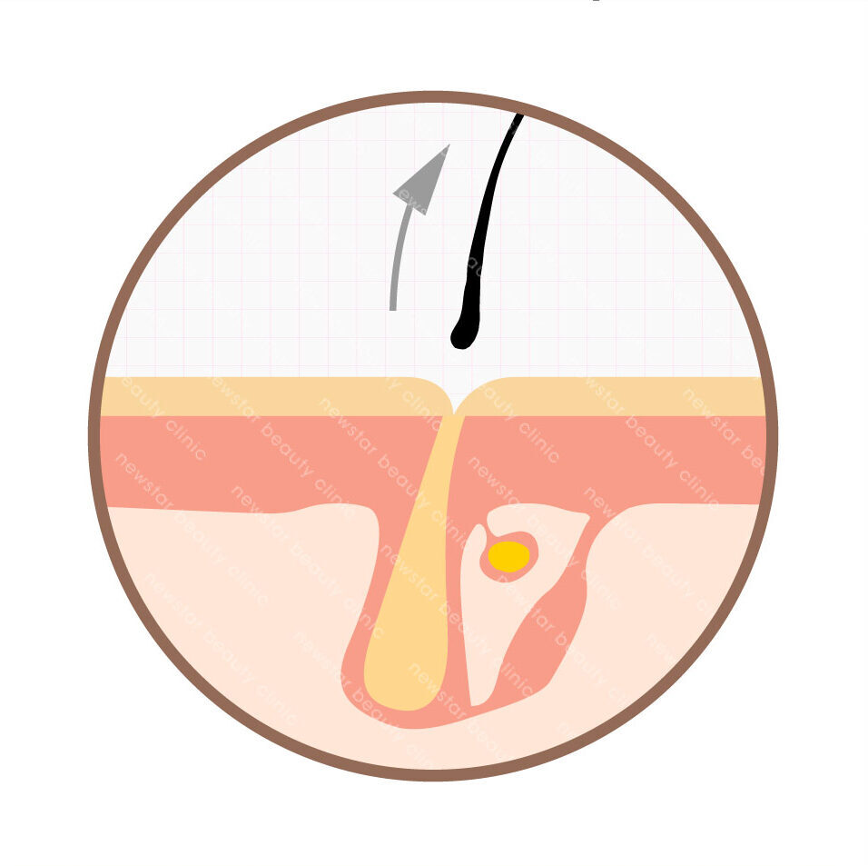 雷射除毛_休止期