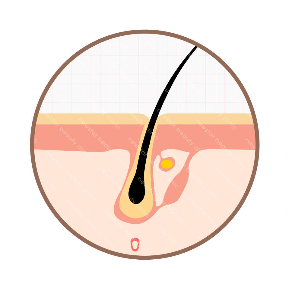 雷射除毛_生長期