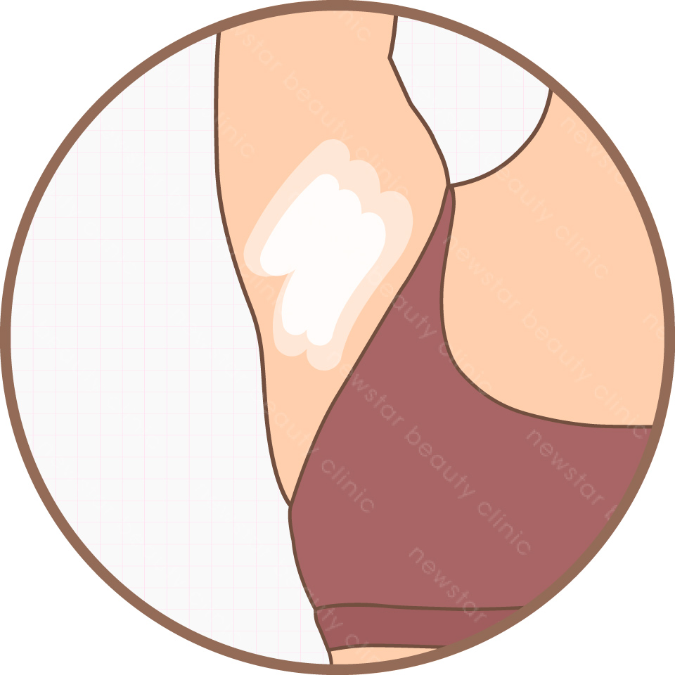 雷射除毛_醫師診斷