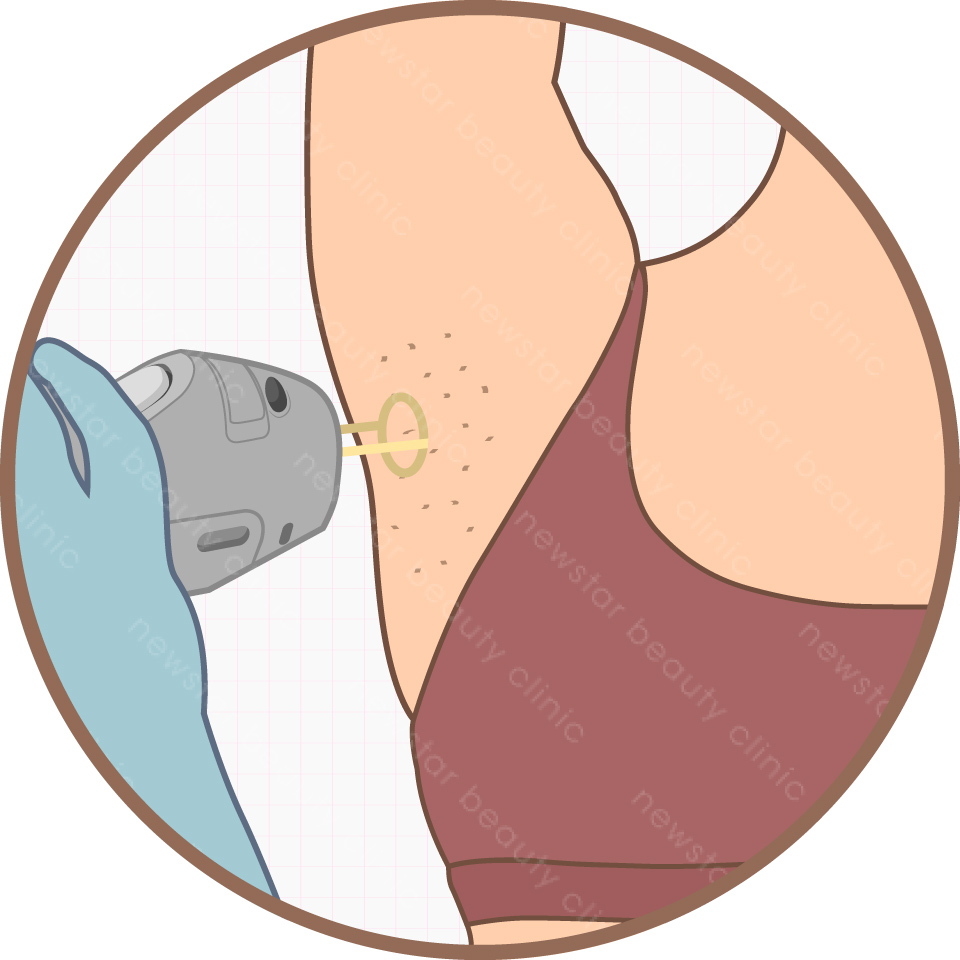 雷射除毛_雷射過程