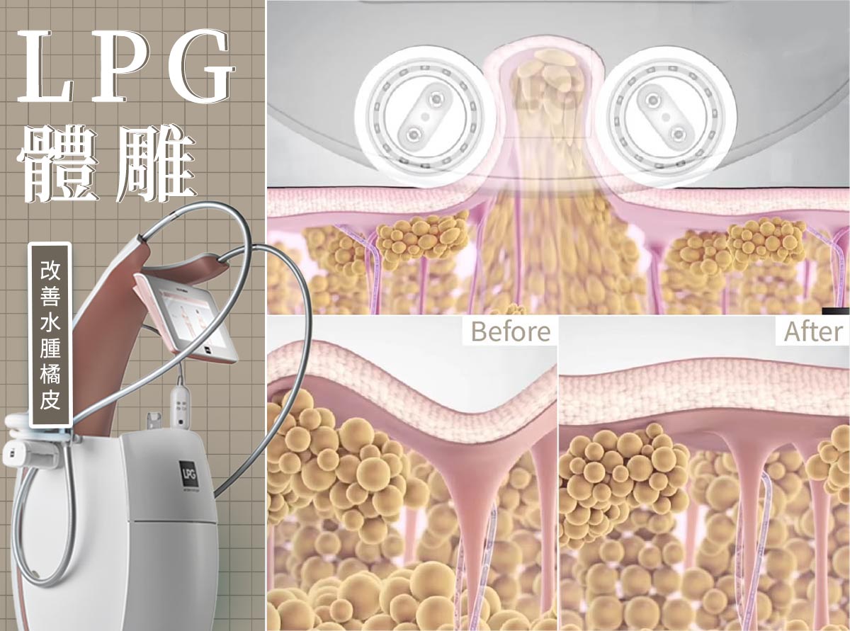瘦小腿方式_LPG體雕