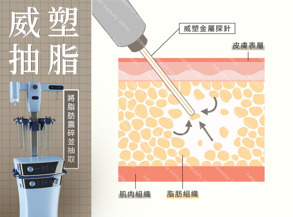 瘦小腿方式_威速抽脂